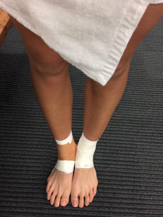 謝淑薇在臉書上秀受傷的腳。摘自謝淑薇臉書